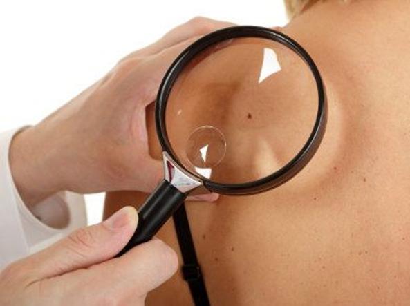 Melanoma: Facciamo chiarezza